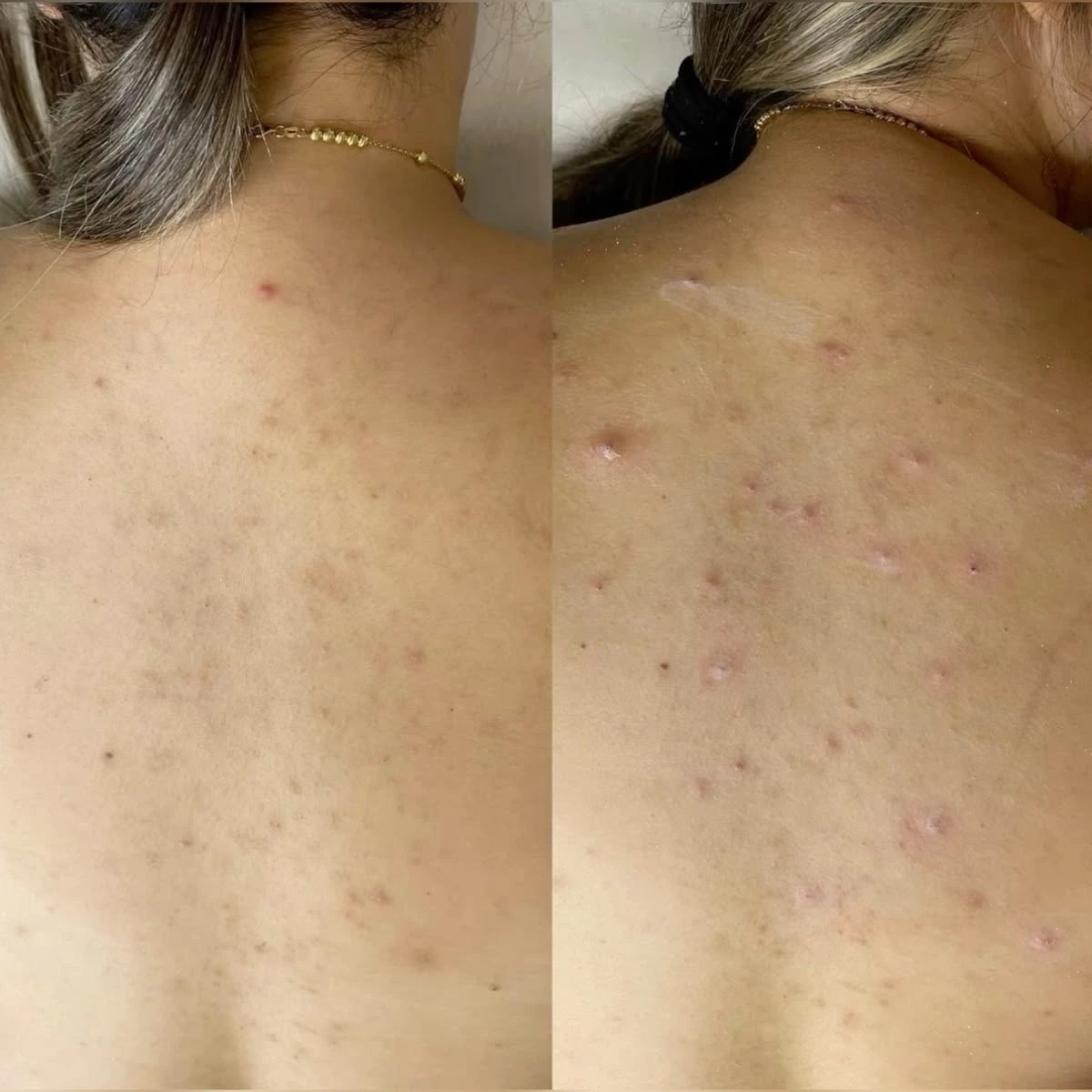 Back Acne Treatment - photo 4
