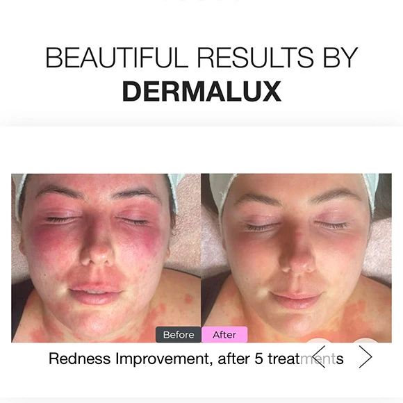 FlexMD Portable LED Light Therapy Mask - photo 4