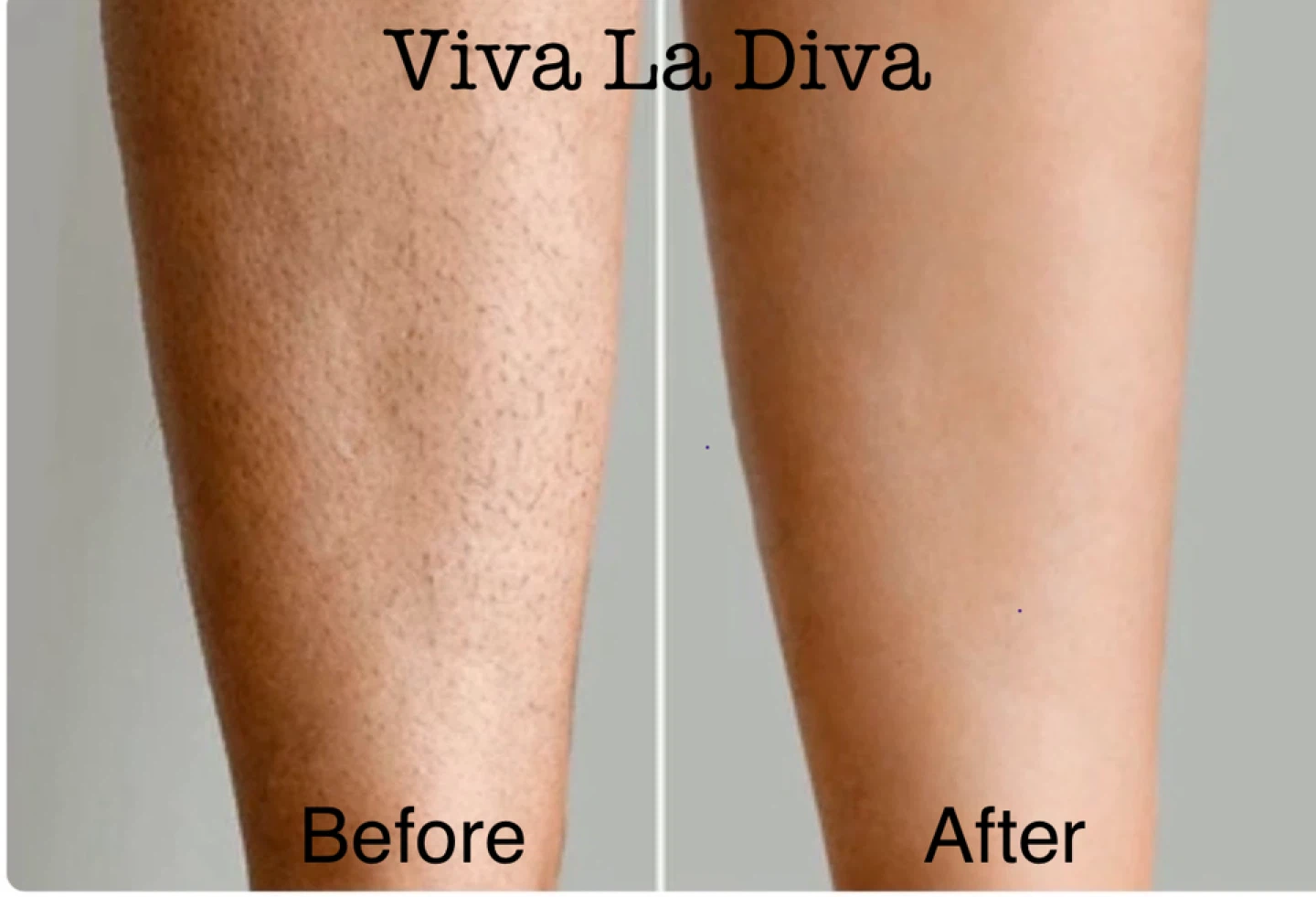 Viva La Diva Hair Removal Before & After Photos - photo 2