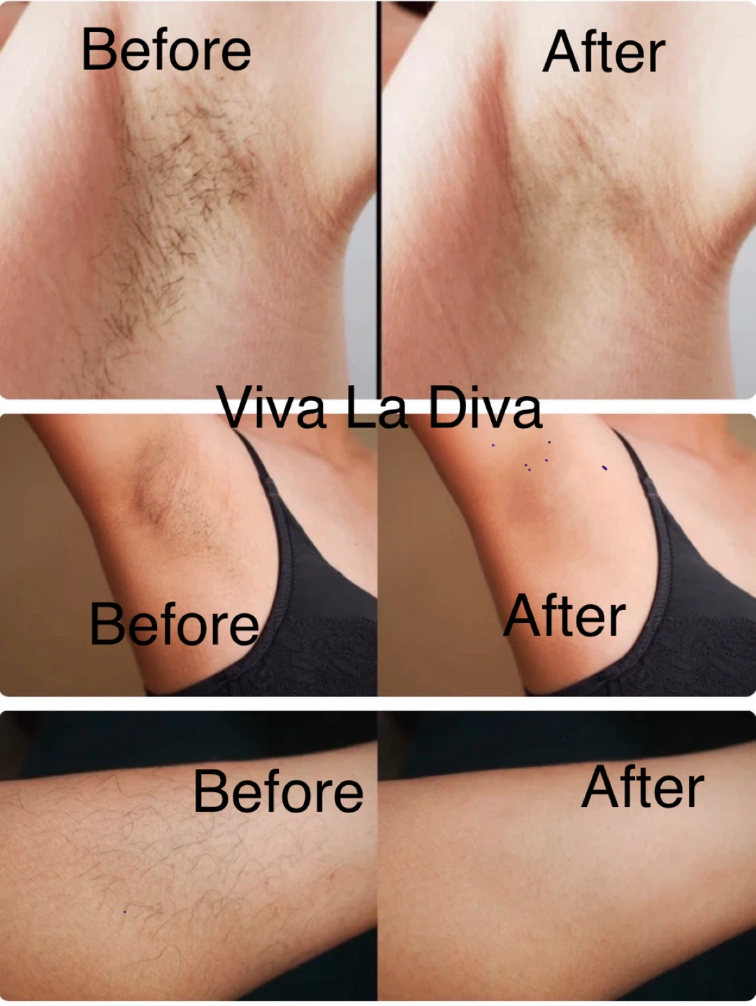 Viva La Diva Hair Removal Before & After Photos