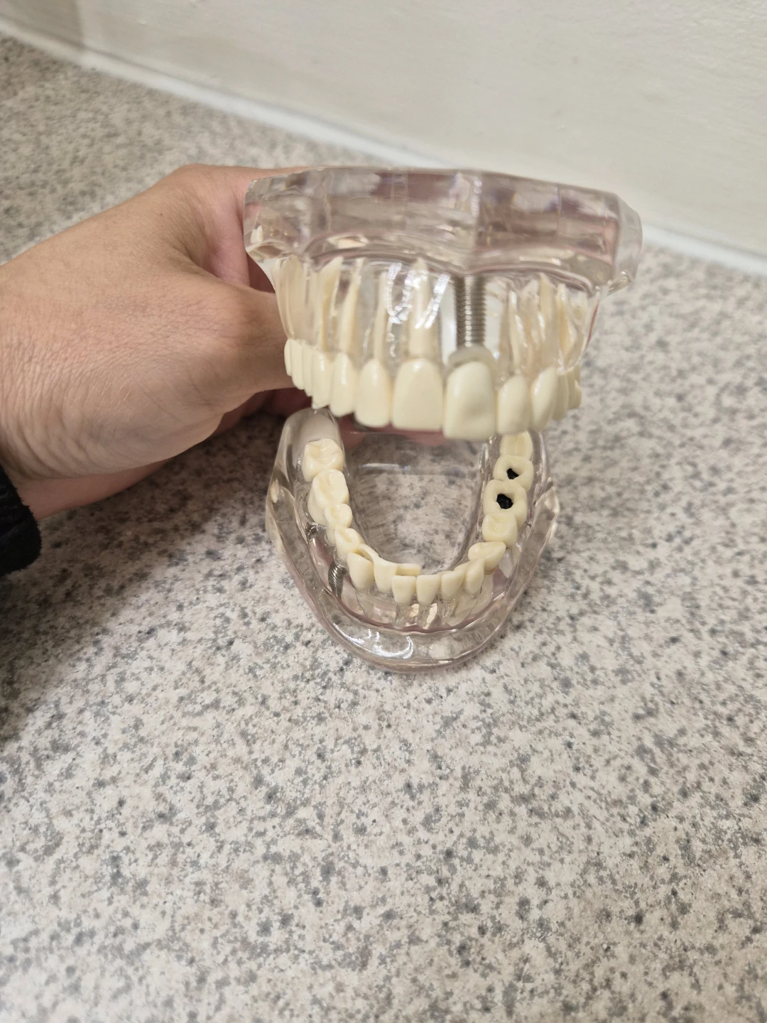 Dental Implant Training Model / Demonstration Model – $15 - photo 2