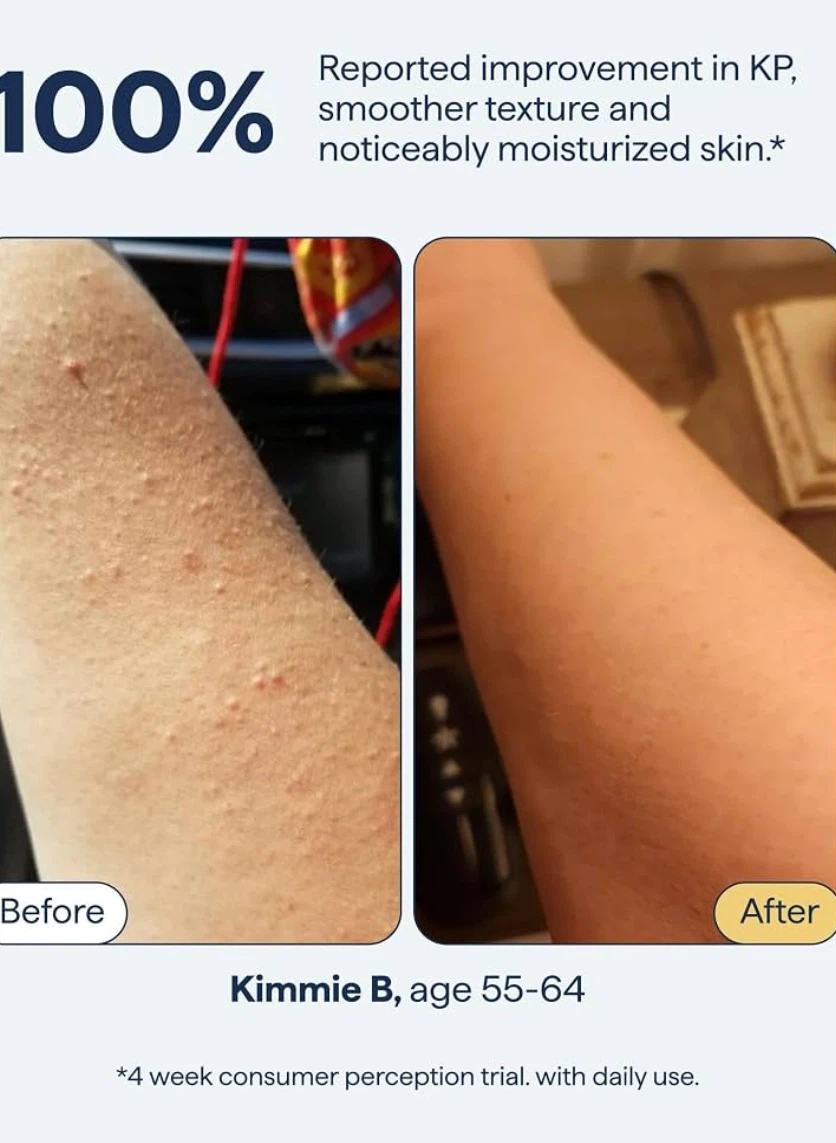 Remedy for body bumps KP and textured skin treatment lotion - photo 4