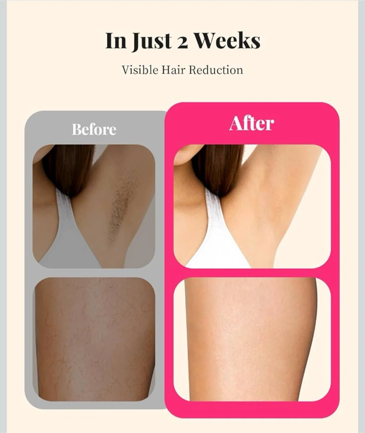 IPL Hair Removal Device with Advanced IGBT Tech - photo 3