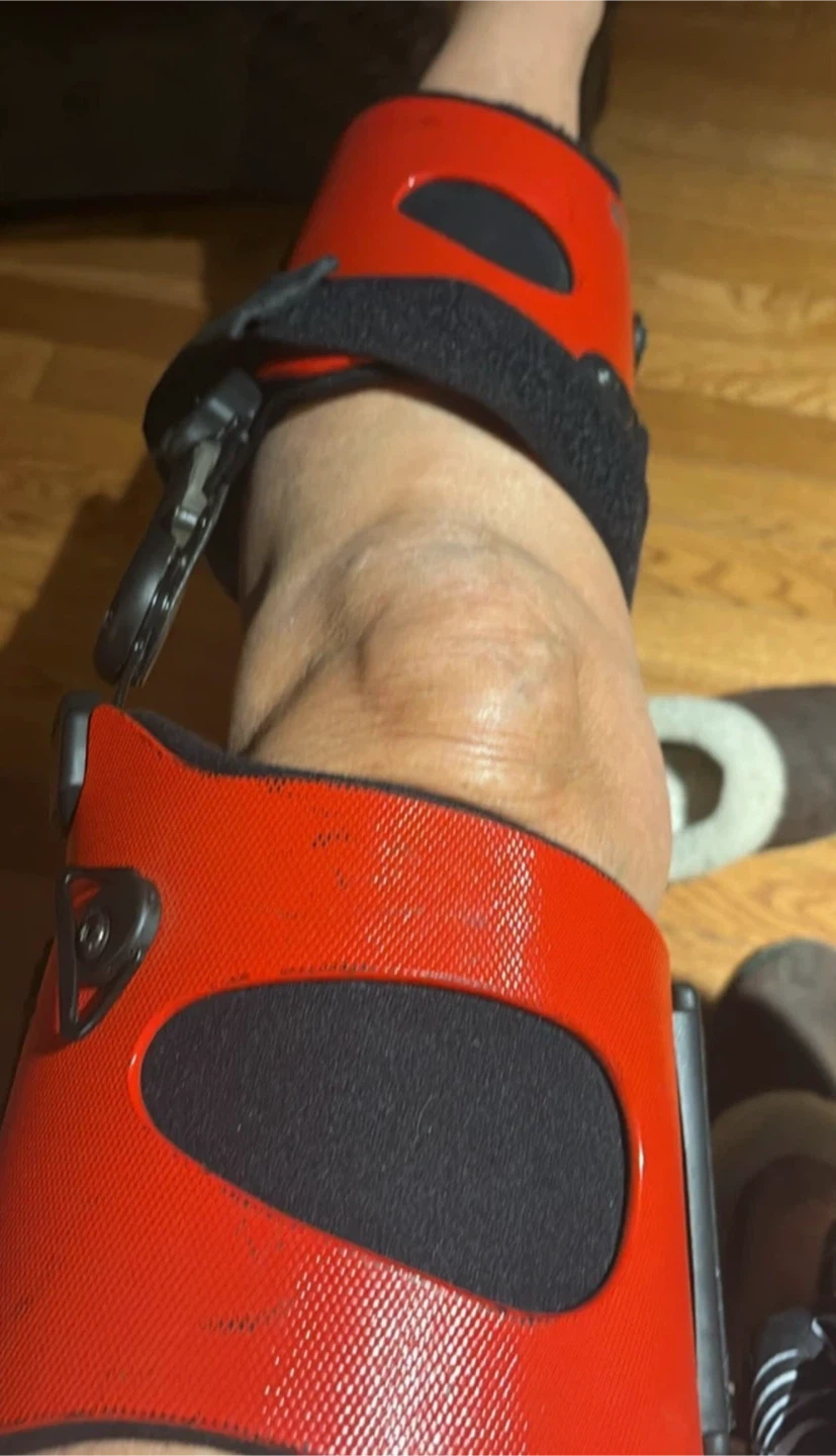 Össur Unloader Custom Knee Brace - photo 2