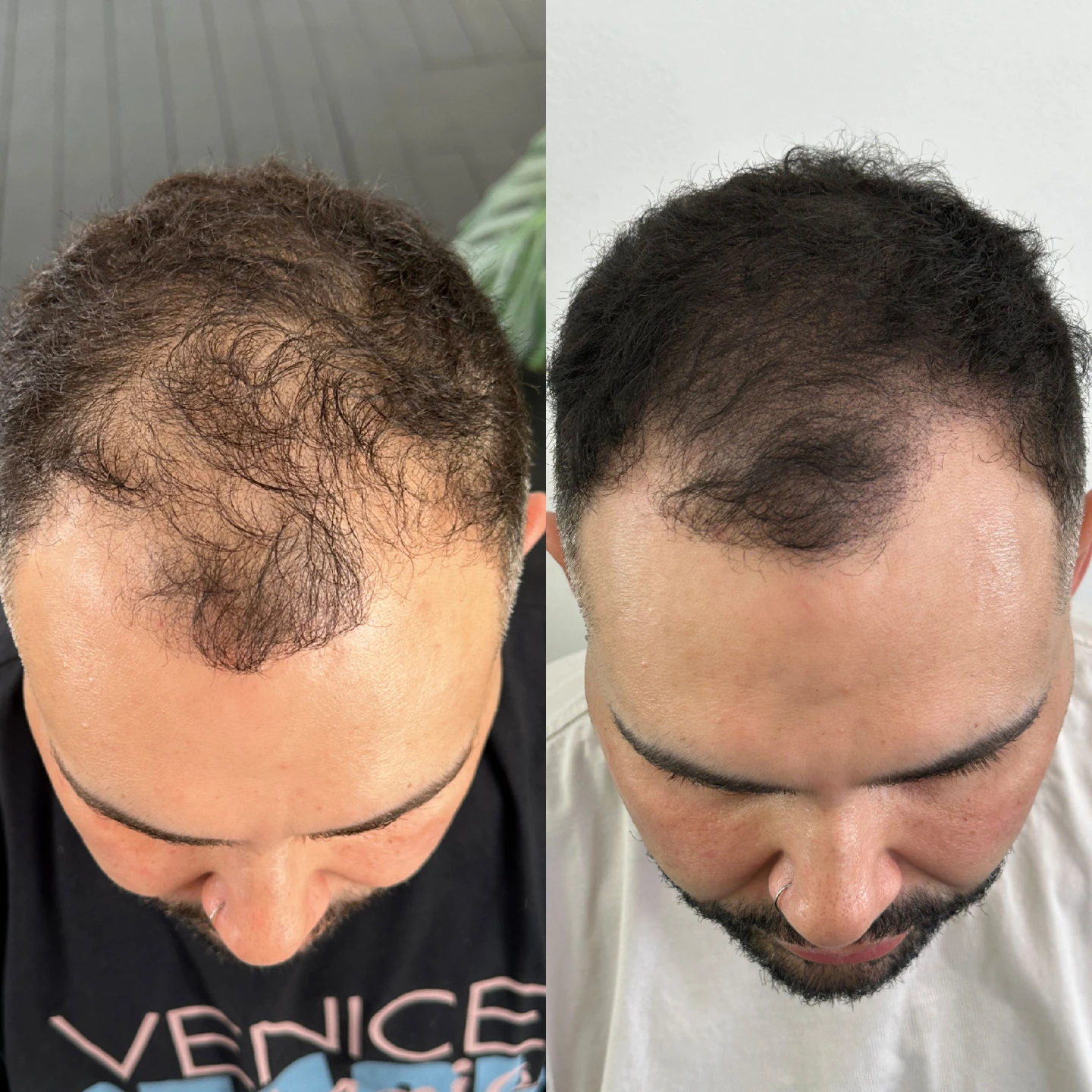 Inkd Calgary Scalp Micropigmentation (SMP) Service - photo 2