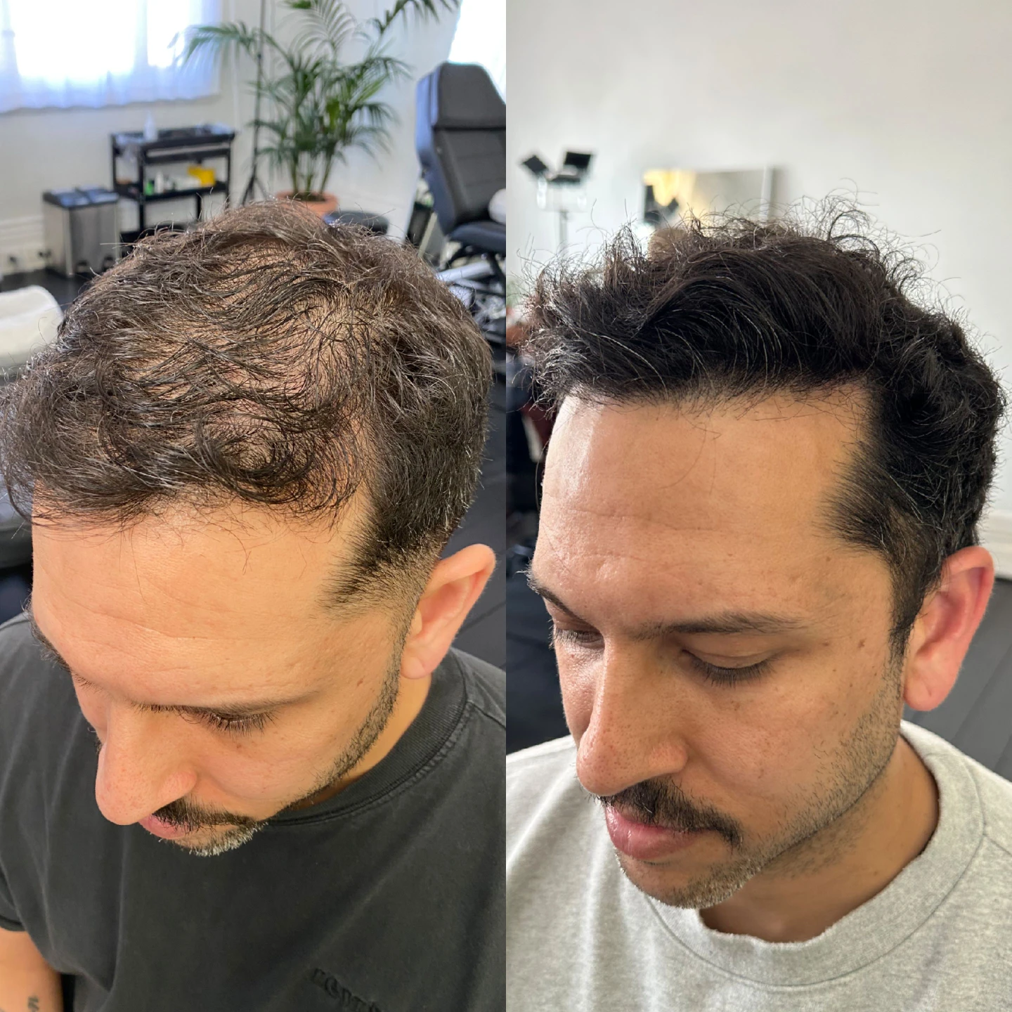 Inkd Calgary Scalp Micropigmentation (SMP) Service - photo 3