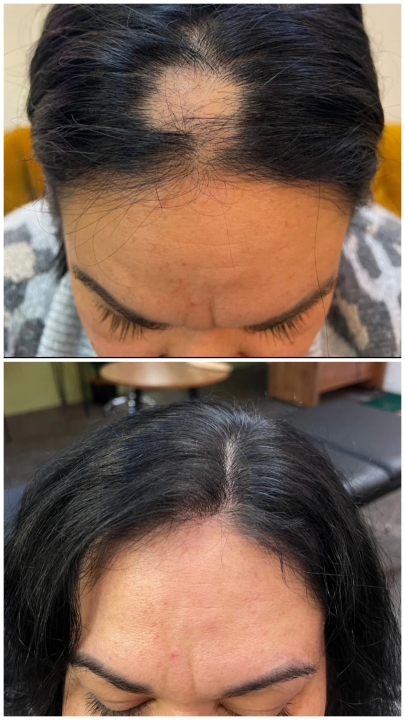 Inkd Calgary Scalp Micropigmentation (SMP) Service - photo 5