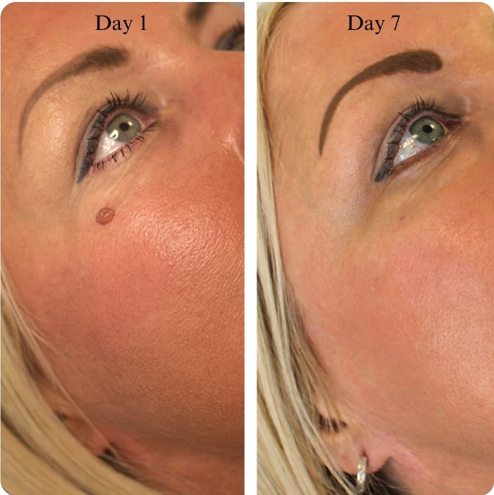 VORA TagBuddy Kit Skin Tag Removal System - photo 3