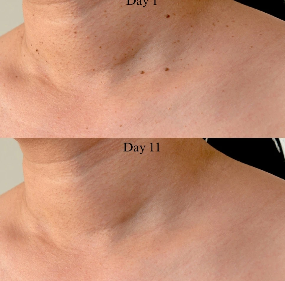 VORA TagBuddy Kit Skin Tag Removal System - photo 4