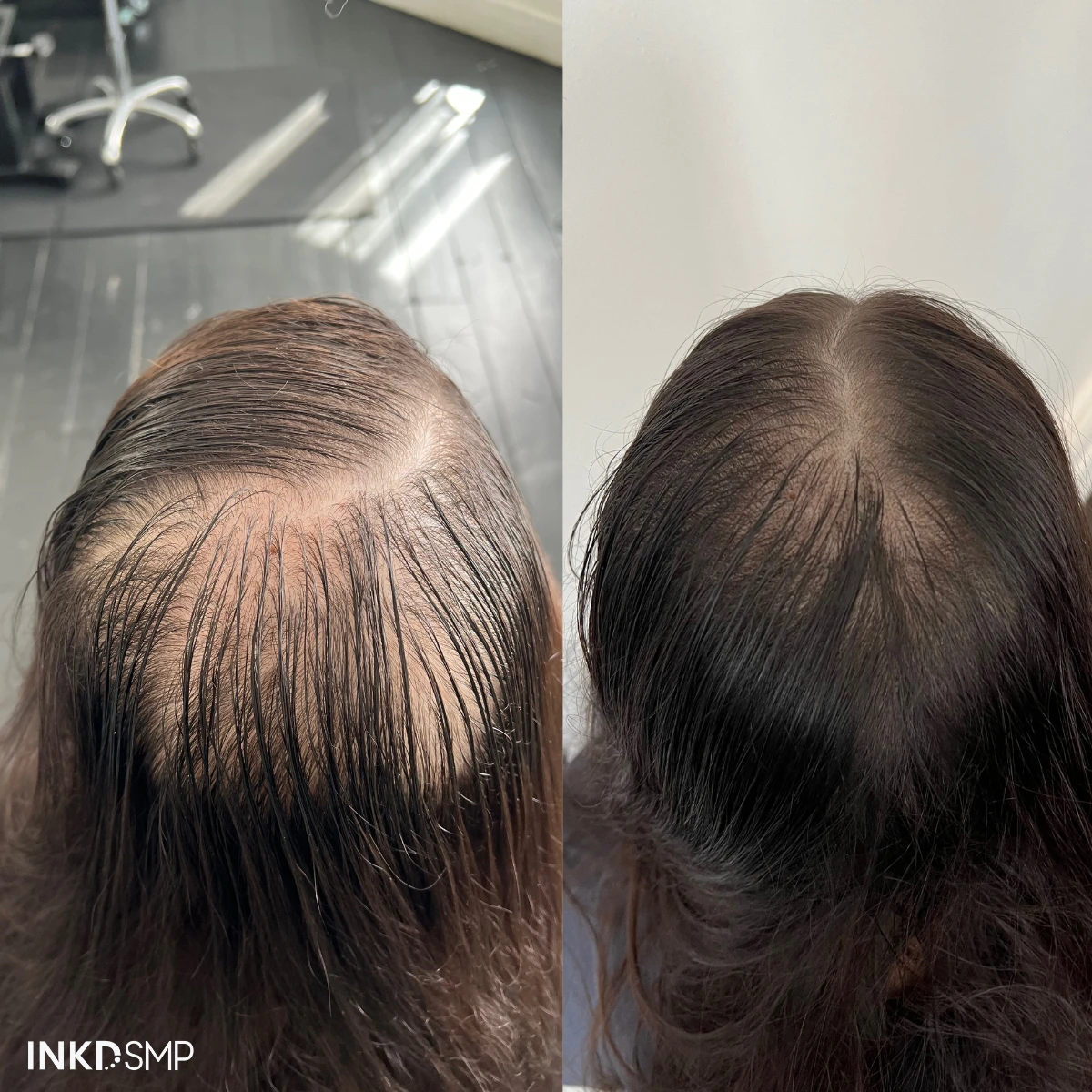 INKD SMP Scalp Micro Pigmentation Services - photo 3