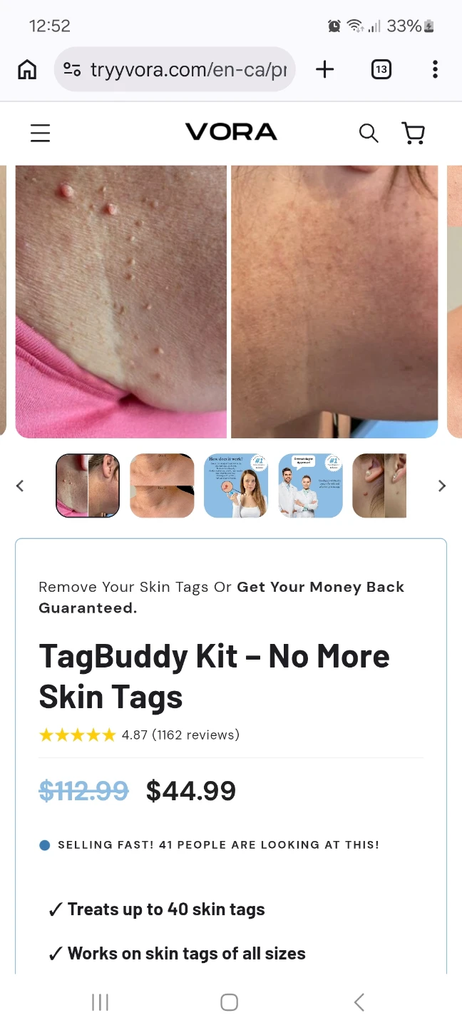 VORA TagBuddy Kit Skin Tag Removal System