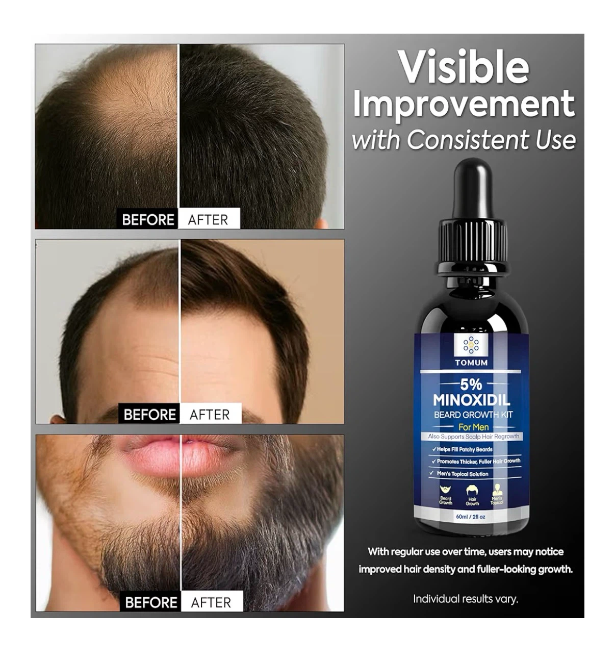 Brand New 5% Minoxidil Beard Growth Kit for Men - photo 3