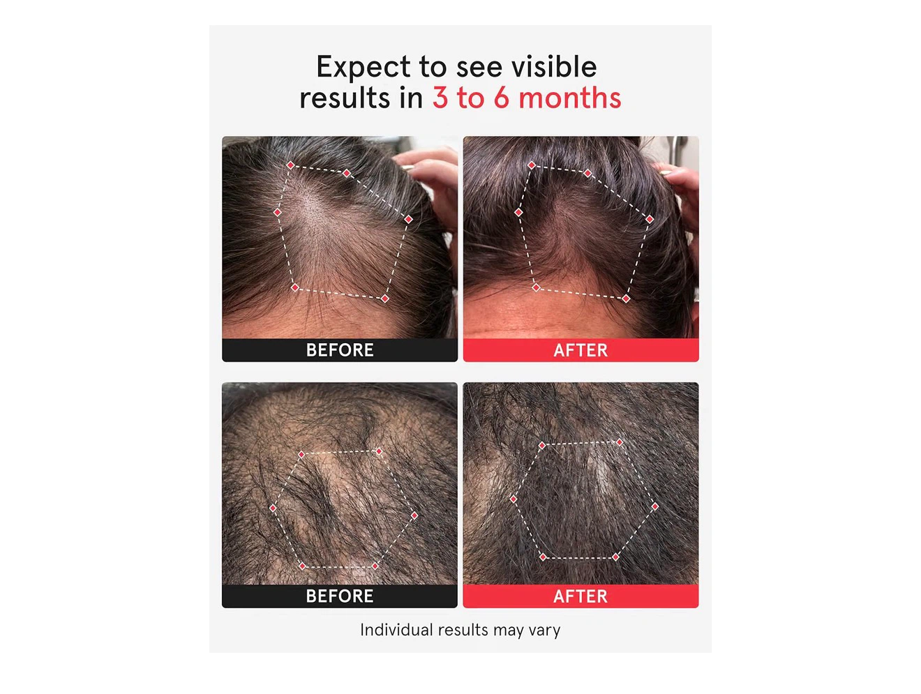iRESTORE Professional Hair Growth Helmet - photo 2