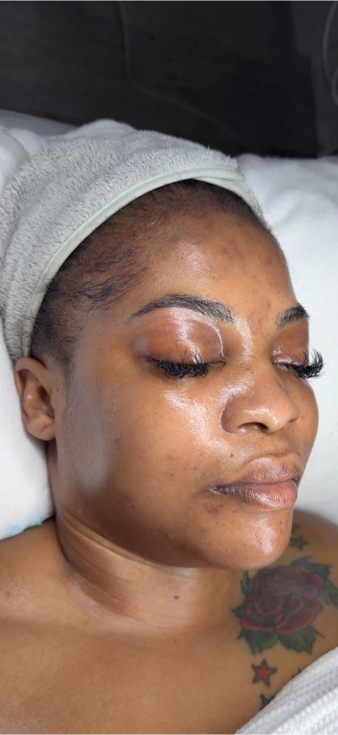 Collagen Facial Before and After Results