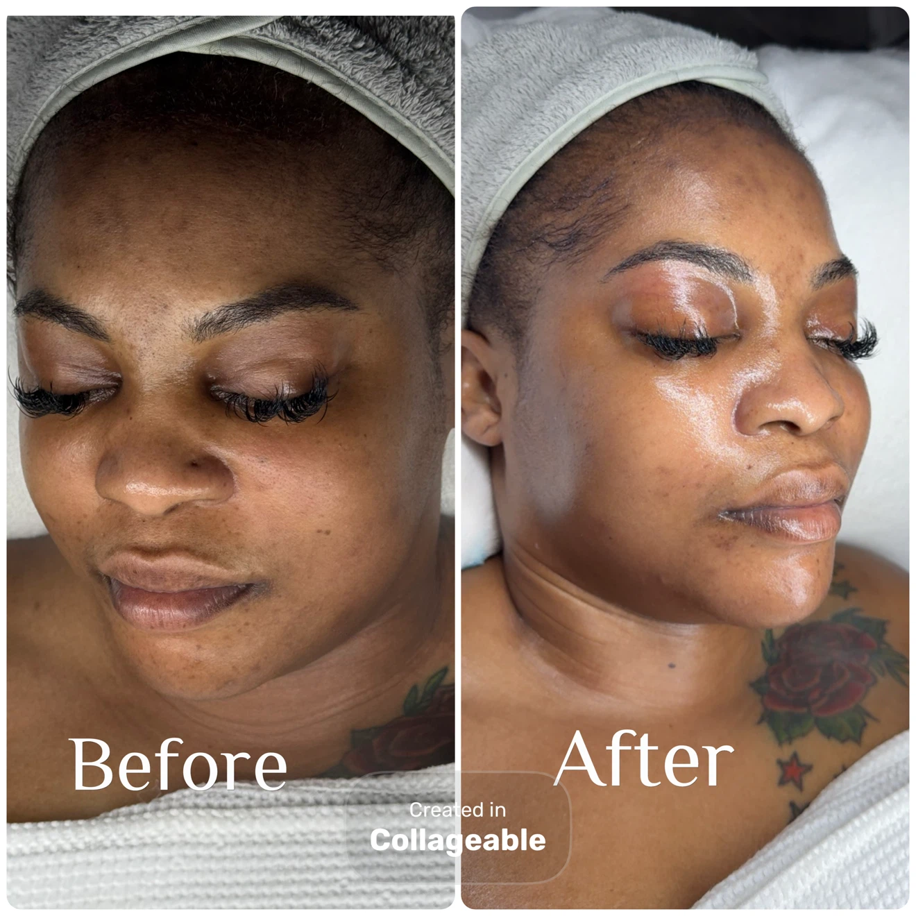 Collagen Facial Before and After Results - photo 2