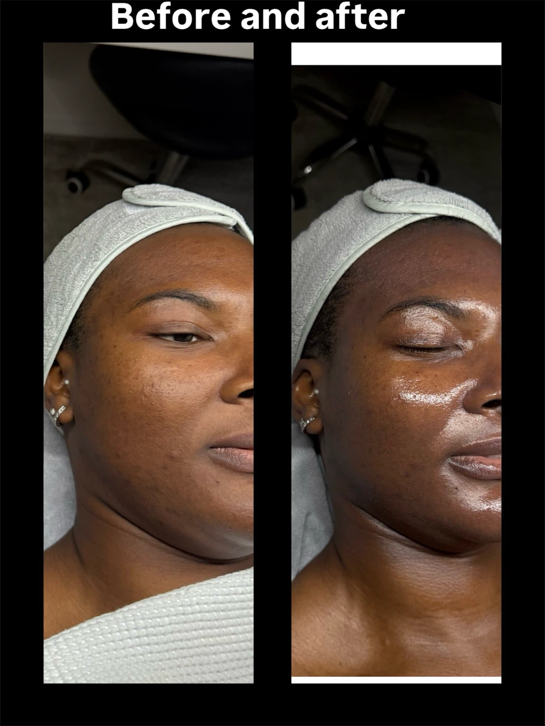 Collagen Facial Before and After Results - photo 3