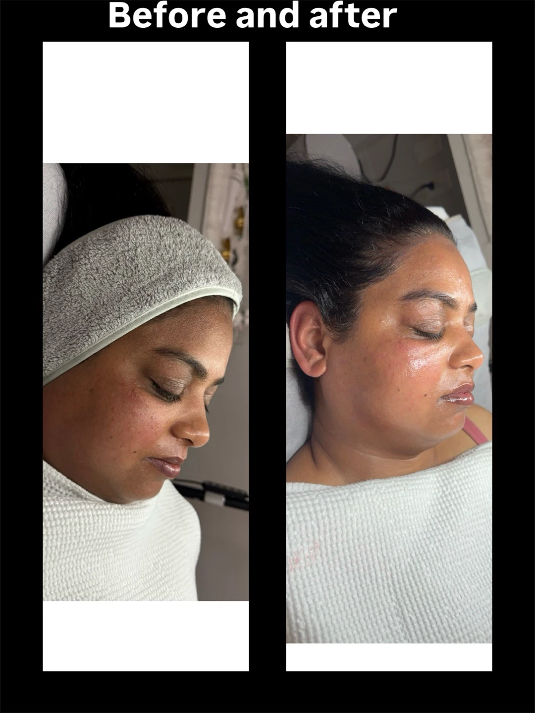 Collagen Facial Before and After Results - photo 4