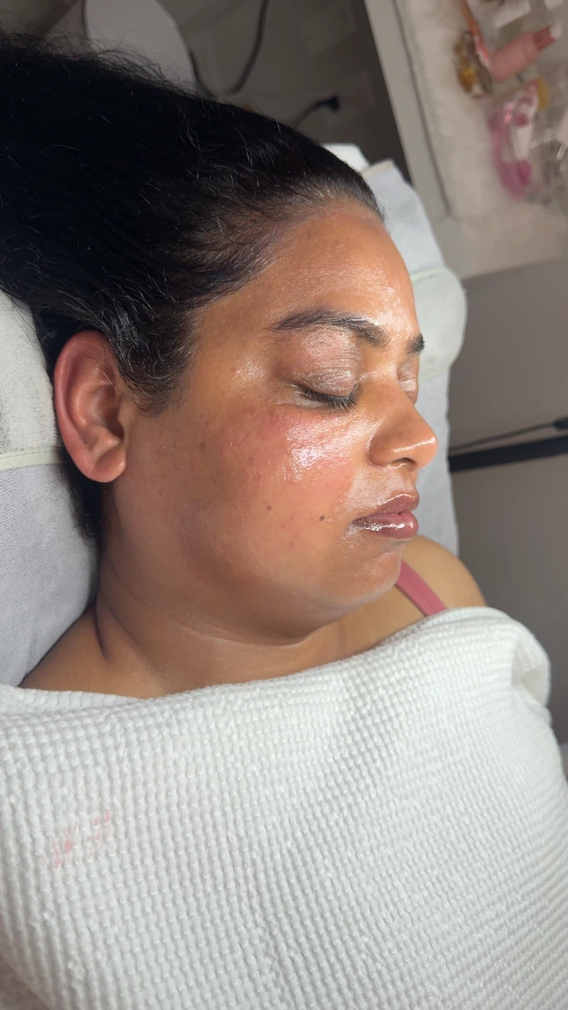Collagen Facial Before and After Results - photo 5