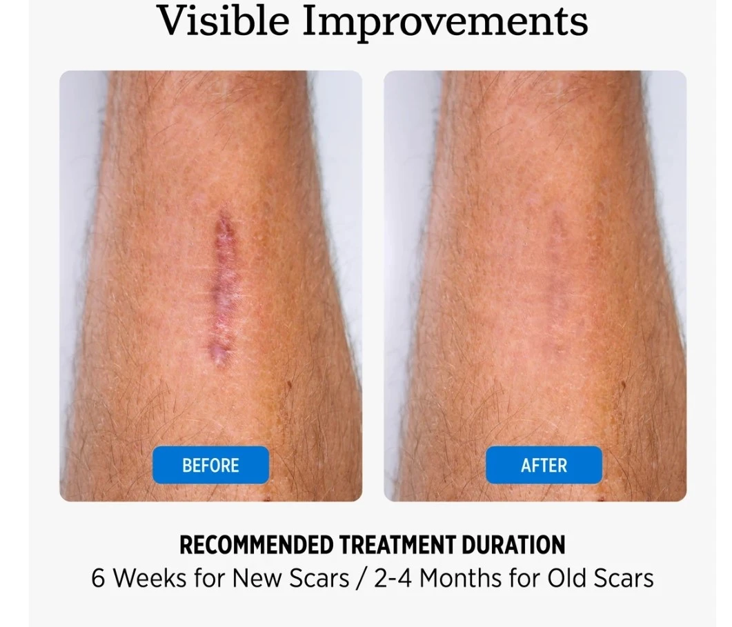 Nuvadermis Silicone Scar Tape - photo 4