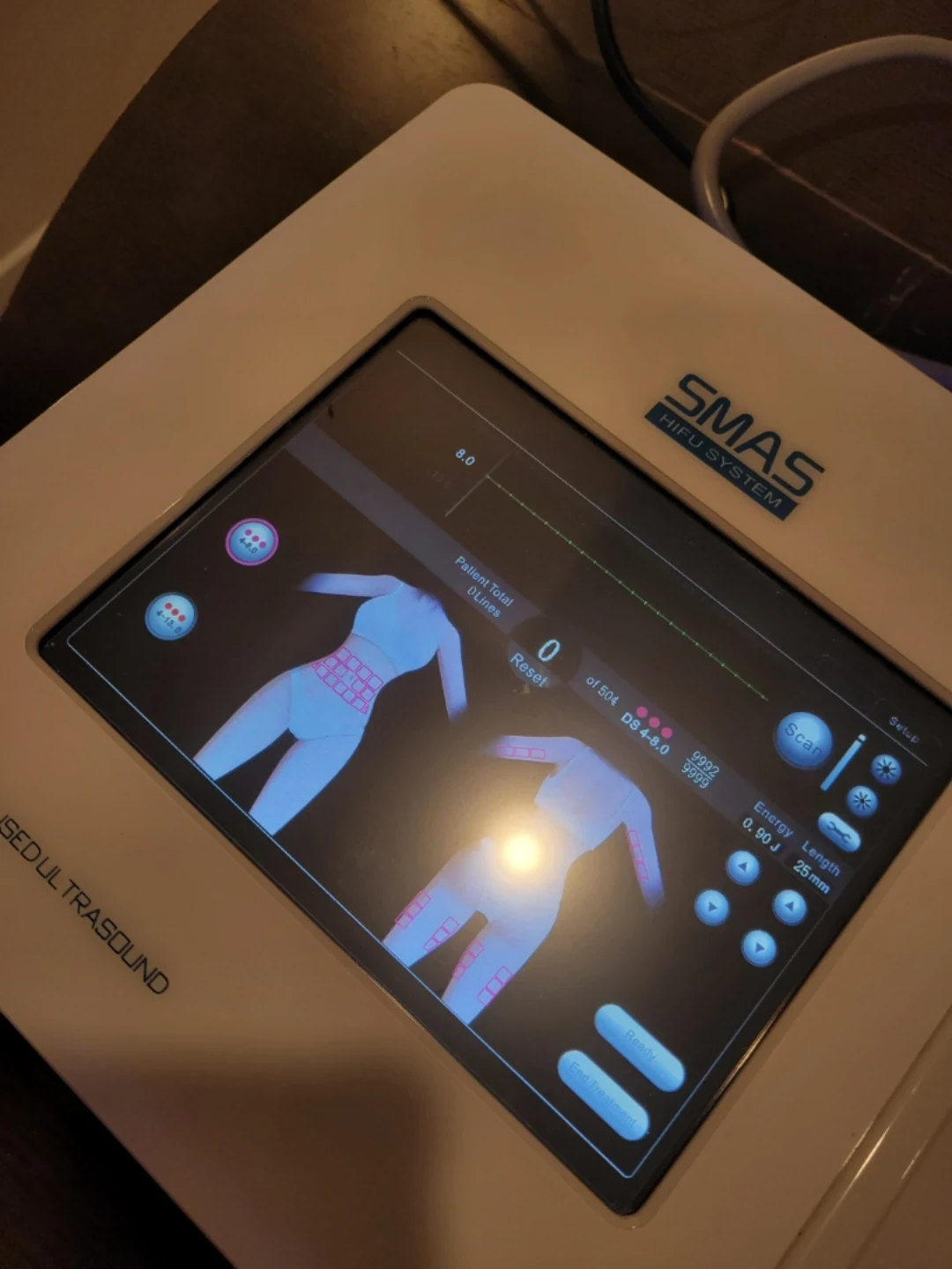 SMAS HIFU High-Intensity Focused Ultrasound Device / Ultherapy - photo 3