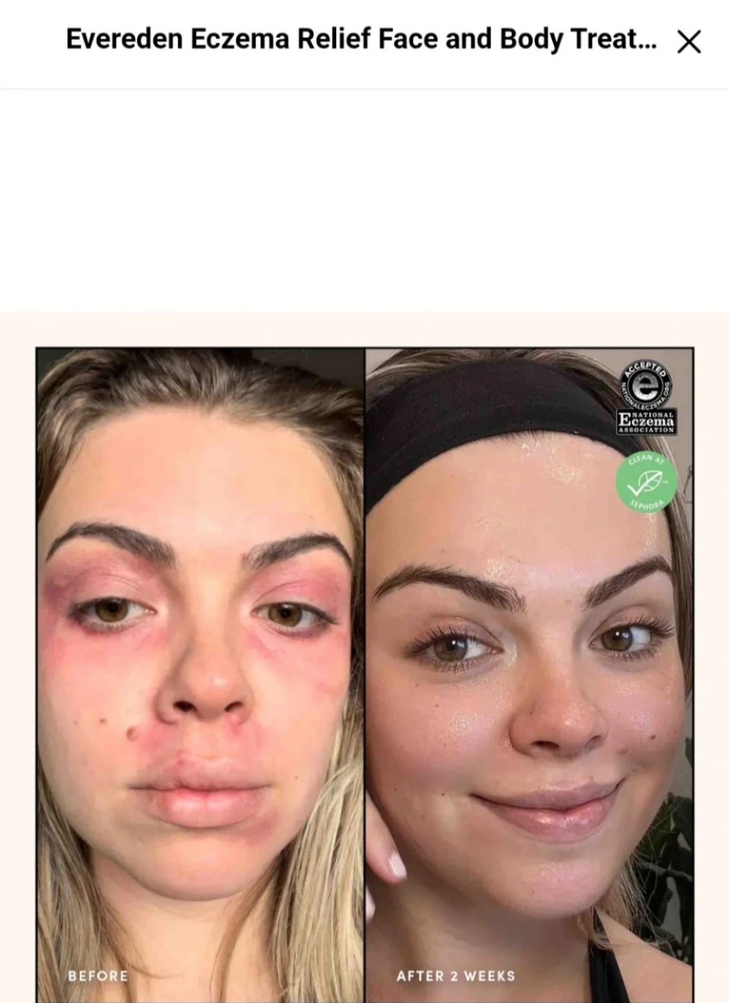 Eczema Relief Cream - photo 4