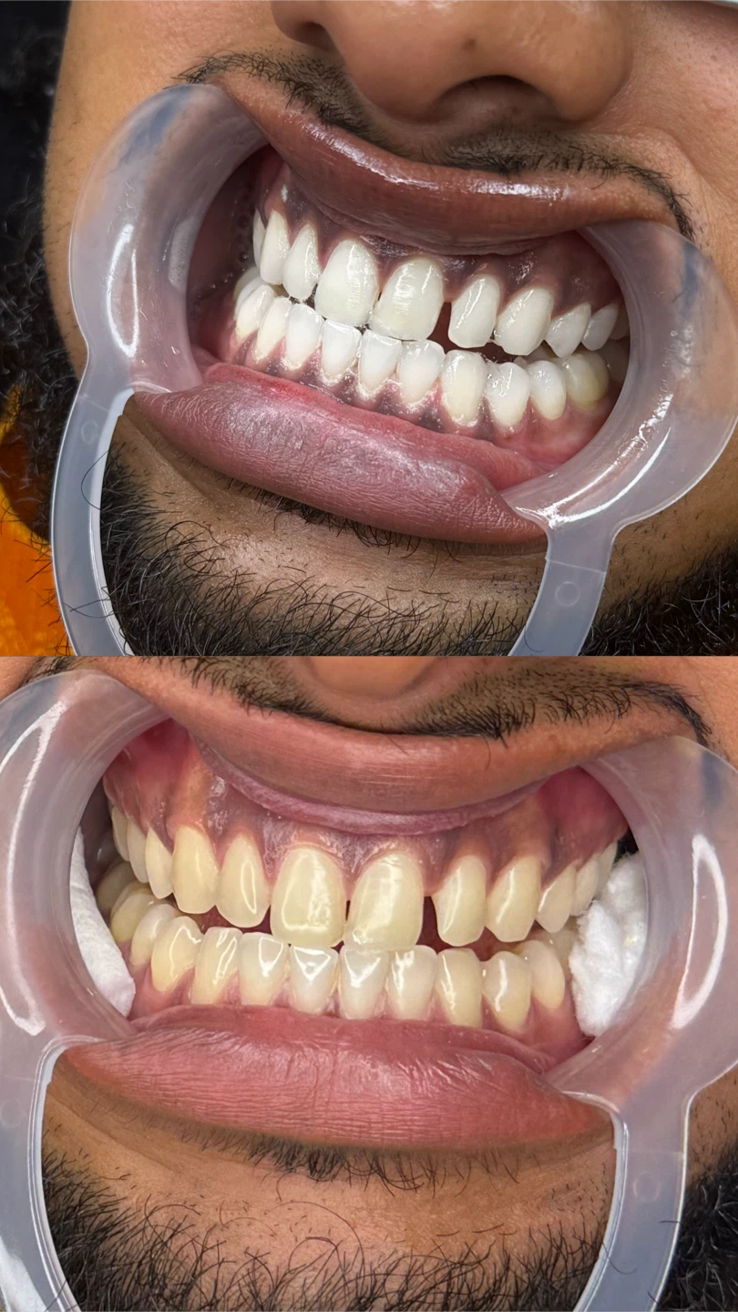Teething whitening- NOVEMBER PROMO