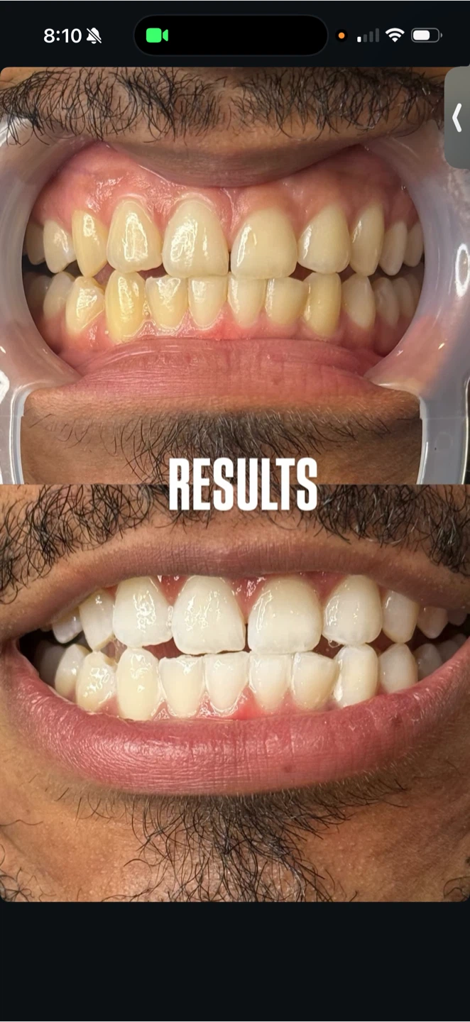 Teething whitening- NOVEMBER PROMO - photo 2